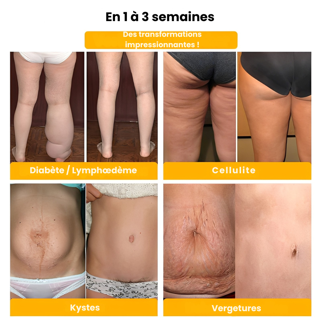 SCULPTRA® – Une Silhouette Affinée et Galbée en 7 Secondes – Sans Sport, Sans Régime, Sans Inconfort