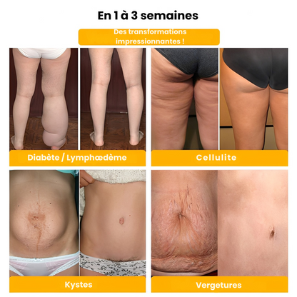 SCULPTRA® – Une Silhouette Affinée et Galbée en 7 Secondes – Sans Sport, Sans Régime, Sans Inconfort