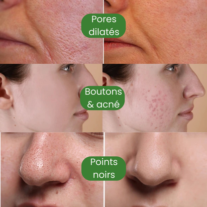 MASK® – Le Stick Nettoyant qui Élimine les Points Noirs en 10 Minutes