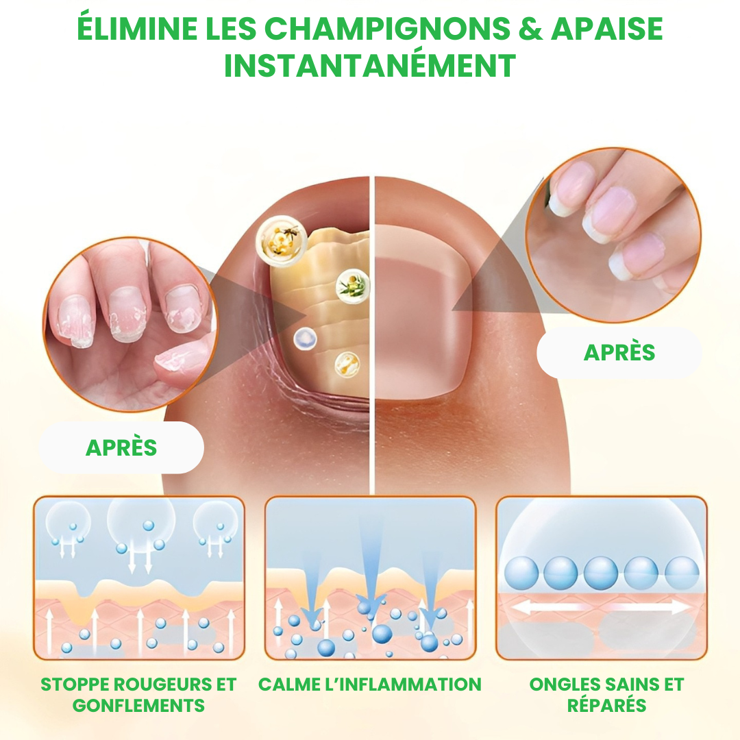 TIMILK® – Éliminez la Mycose en 7 Jours – Spray Réparateur d’Ongles Rapide et Efficace – Retrouvez Confiance et Beauté Naturelle