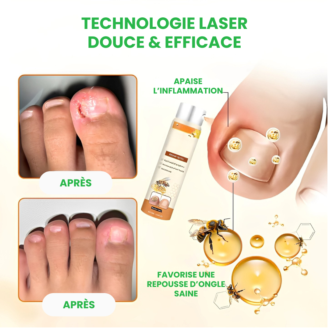 TIMILK® – Éliminez la Mycose en 7 Jours – Spray Réparateur d’Ongles Rapide et Efficace – Retrouvez Confiance et Beauté Naturelle