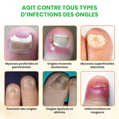 TIMILK® – Éliminez la Mycose en 7 Jours – Spray Réparateur d’Ongles Rapide et Efficace – Retrouvez Confiance et Beauté Naturelle