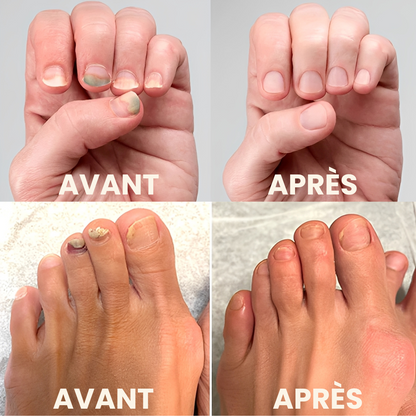 TIMILK® – Éliminez la Mycose en 7 Jours – Spray Réparateur d’Ongles Rapide et Efficace – Retrouvez Confiance et Beauté Naturelle